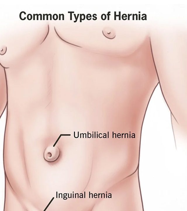 Abdominal Wall Hernias