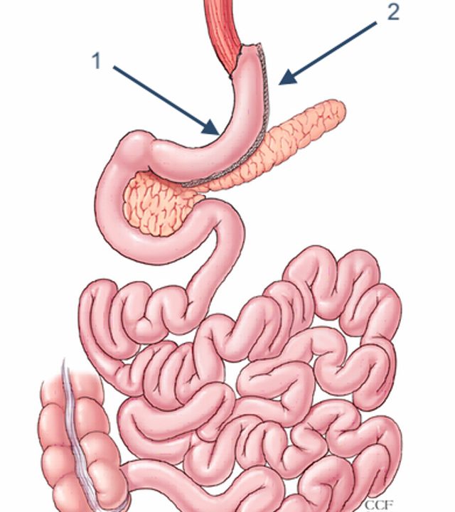 Bariatric Surgery Metabolic Surgeries