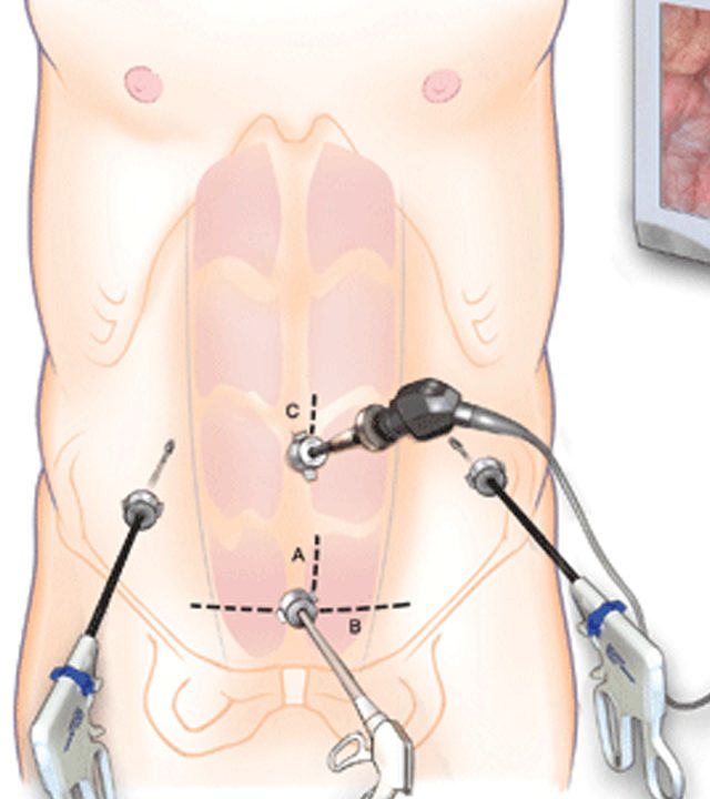 Colorectal Surgeries