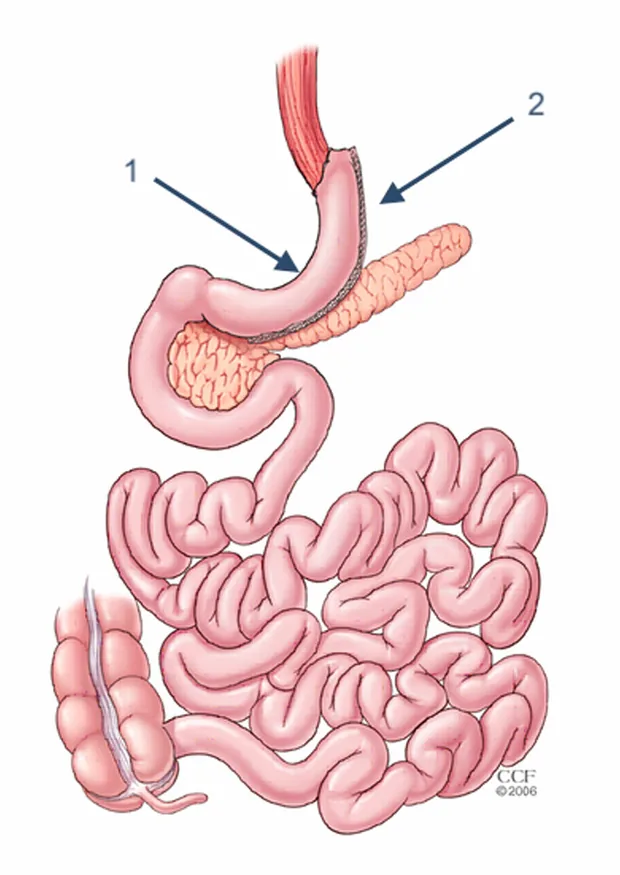 Bariatric & Metabolic Surgeries