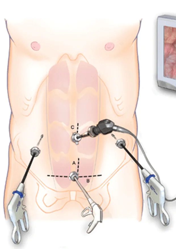 Colorectal Surgeries