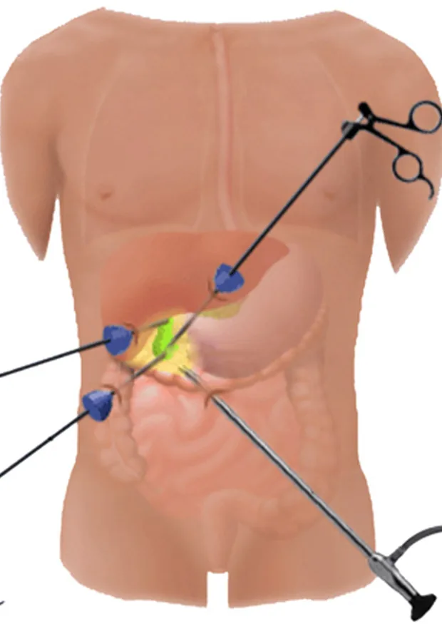 Solid Organ Surgeries
